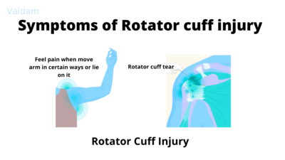  Symptoms of Rotator cuff injury and need for shoulder arthroscopy surgery.