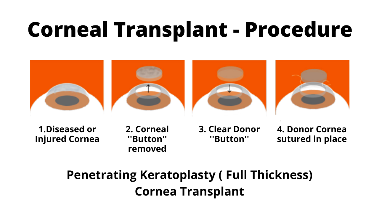  Procedure for Cornea Transplant.