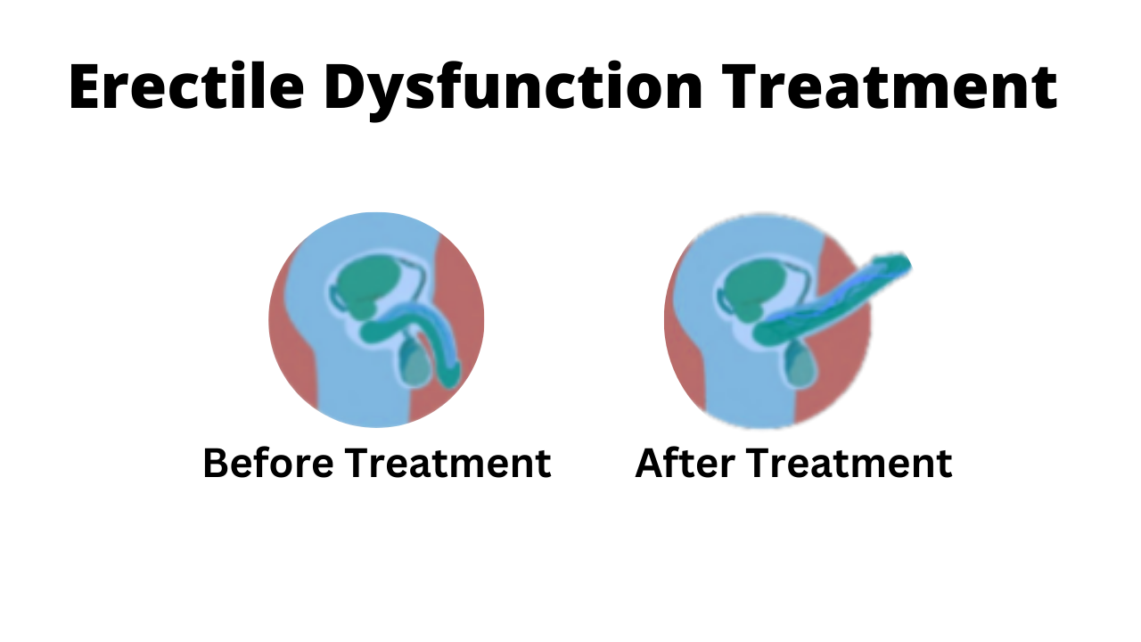  Before and after erectile dysfunction treatment.