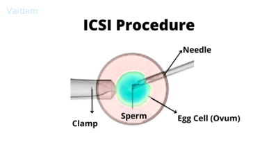 El procedimiento de ICSI.