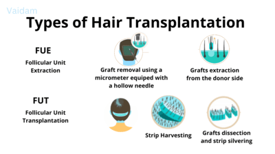  Types of Hair Transplant.