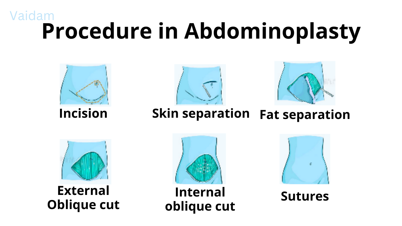 Procedure in Abdominoplasty.