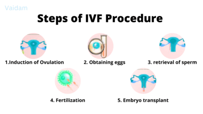 Steps in IVF procedure.