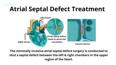  Treatment for Atrial Septal Defect.