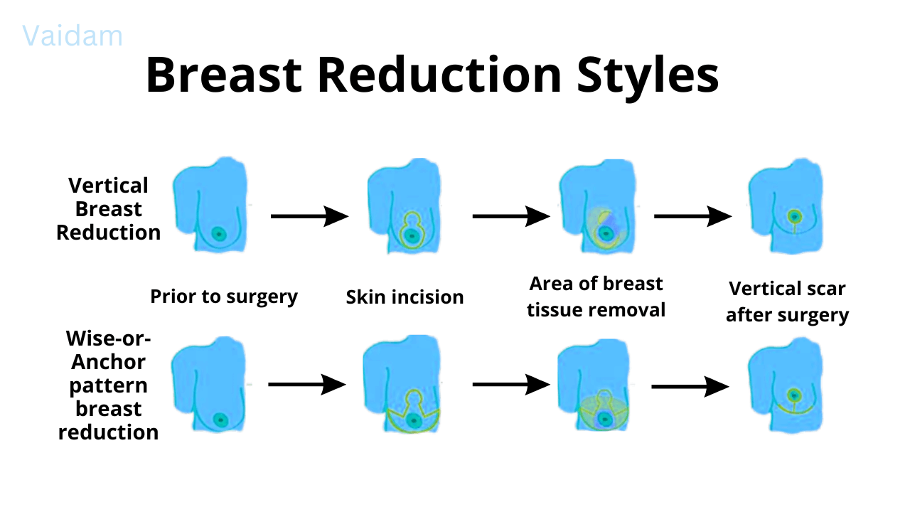 Stiluri în reducerea sânilor.
