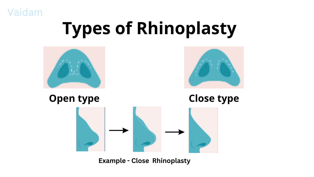 Types of Rhinoplasty.