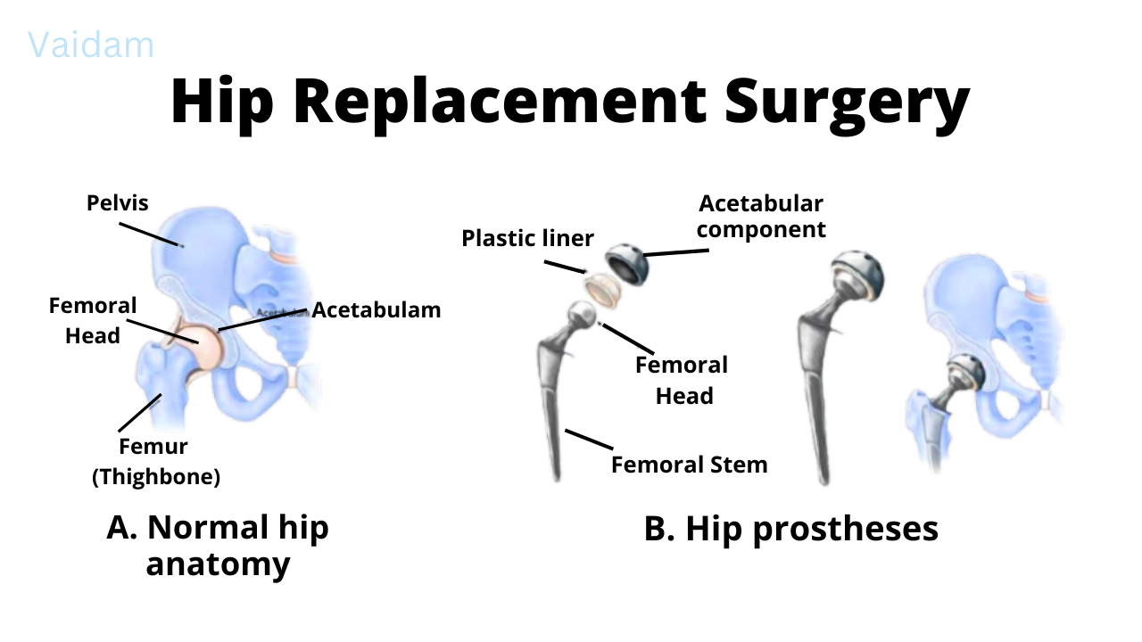  Details on Hip Replacement Surgery
