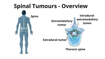 Overview of Spine Tumor surgery.