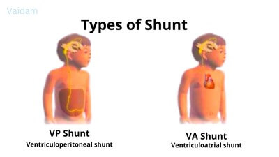 Types of Shunt.