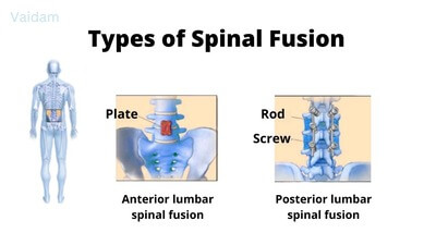 Types of Spine Fusion Surgery.