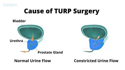 Causes for TURP surgery.