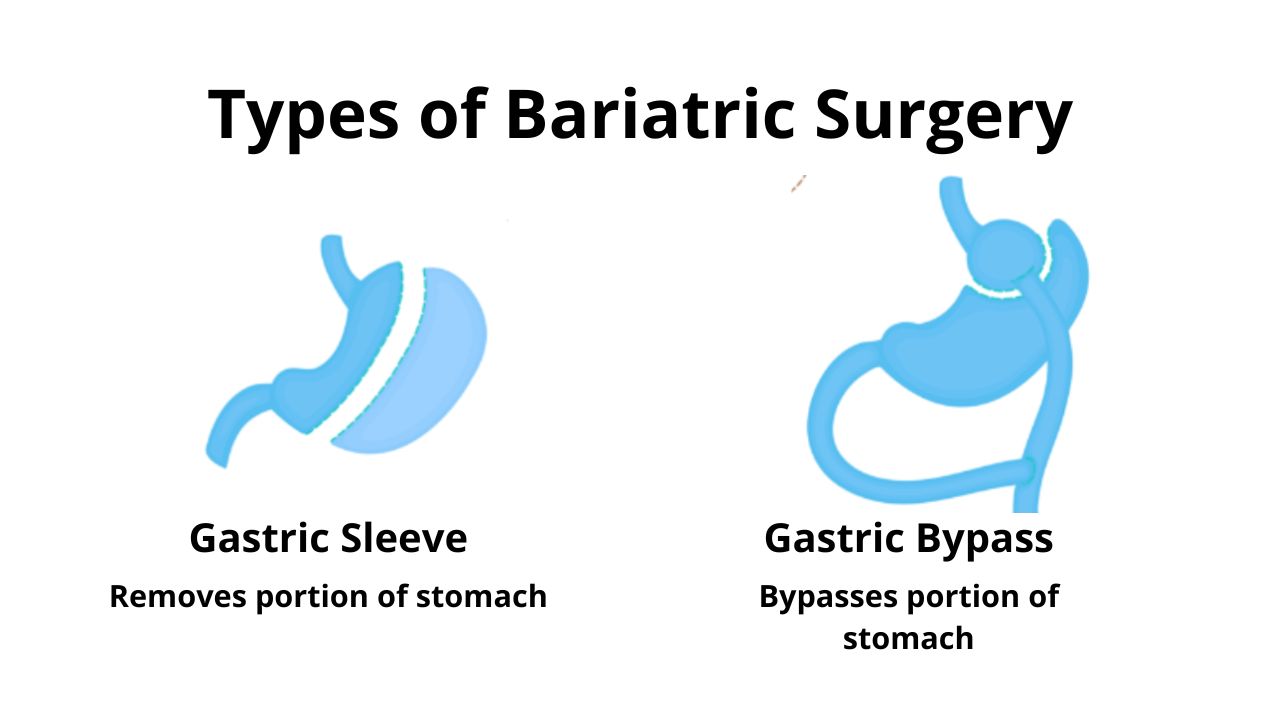  Types of Bariatric Surgery.