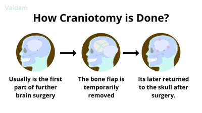 How Craniotomy Surgery is done?