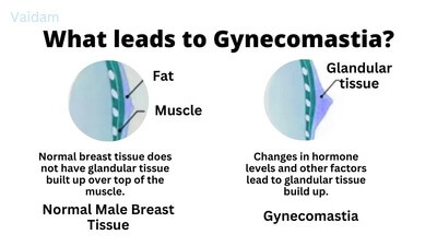 What leads to Gynecomastia?
