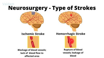  Types of strokes treated by Neurosurgery.