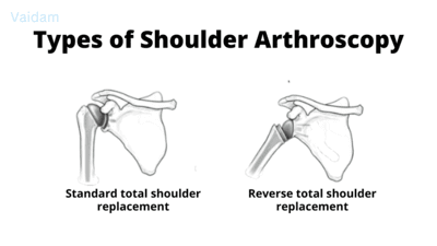 Types of shoulder arthroscopy surgery.
