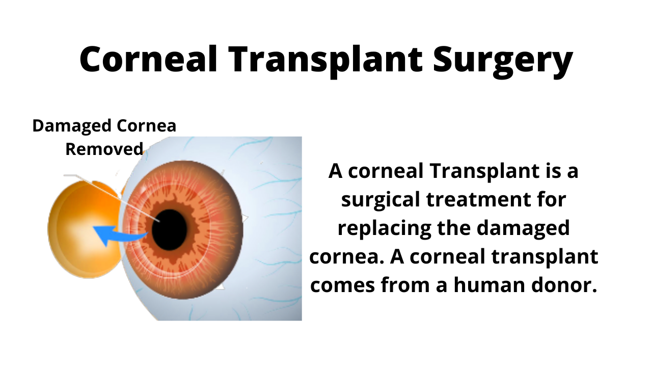  What is Cornea Transplant surgery?