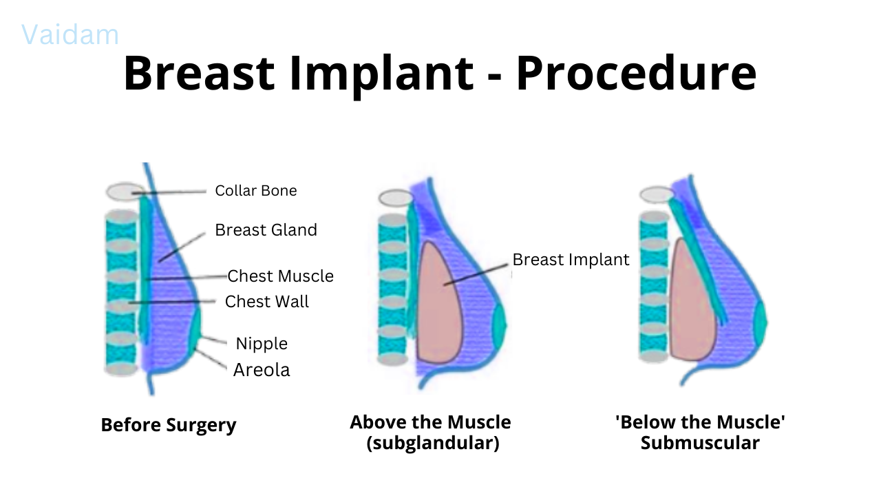 Procedure for breast implants.