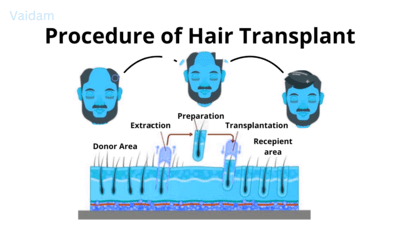 إجراءات زراعة الشعر.