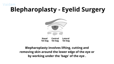  Blepharoplasty - Eyelid surgery.