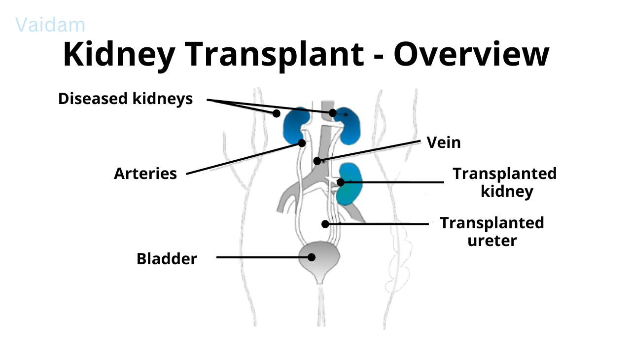 Overview of Kidney Transplant.