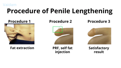 The procedure of Penile Lengthening surgery.