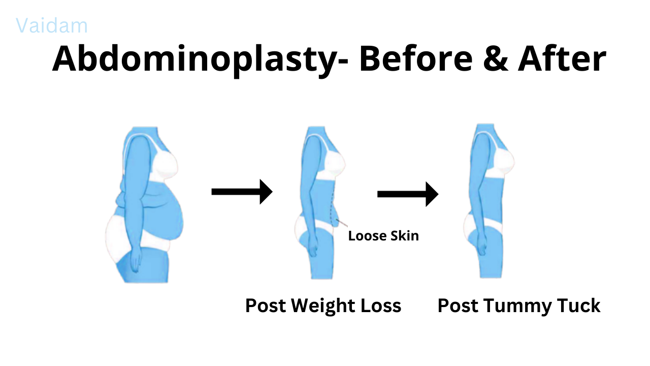 Before and after image of Abdominoplasty.