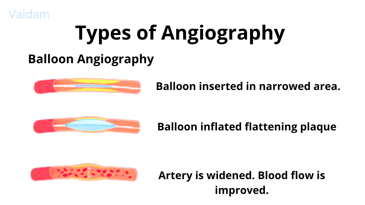 Types of Angiography.