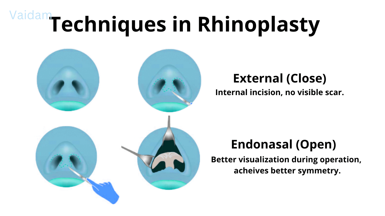 Techniques in Rhinoplasty.