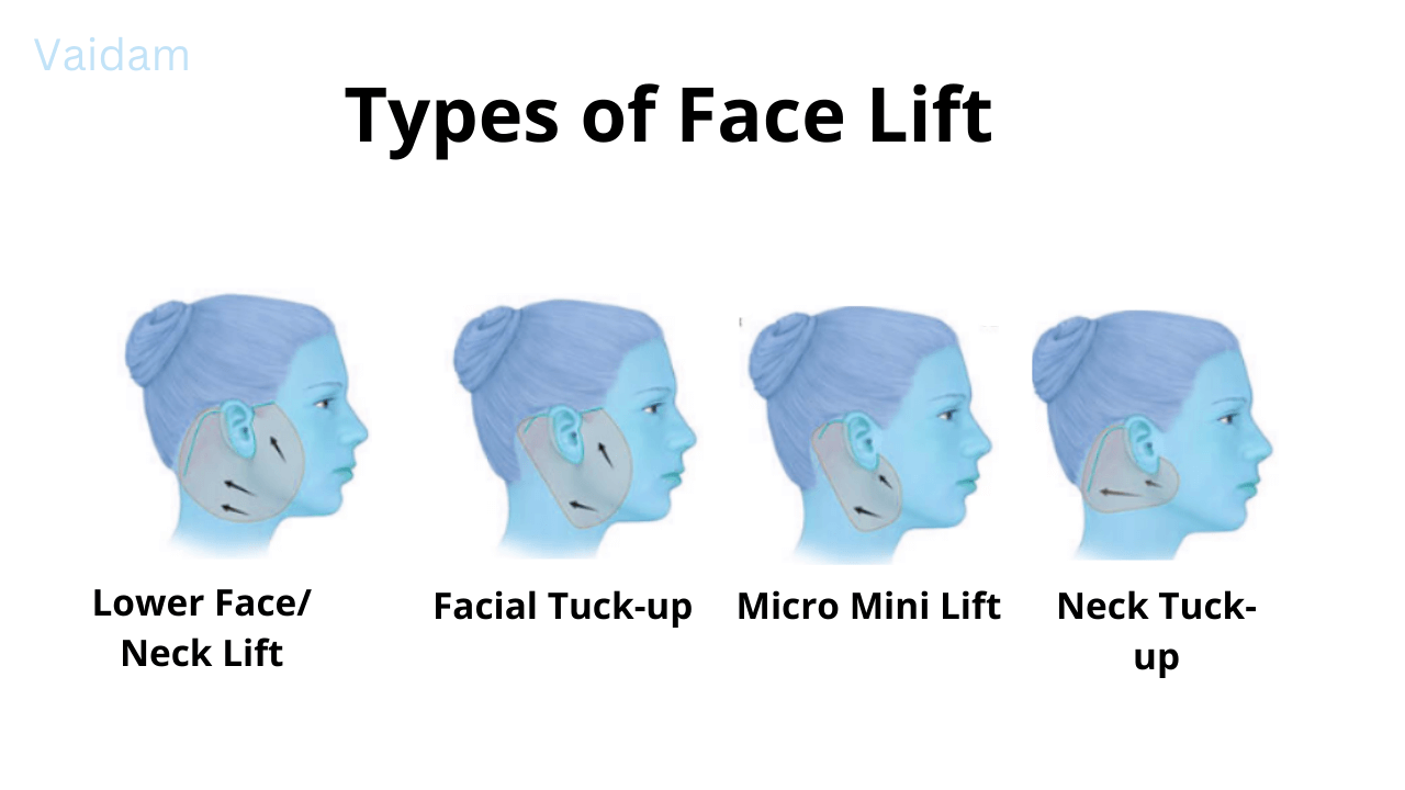  Types and regions of Face Lift.