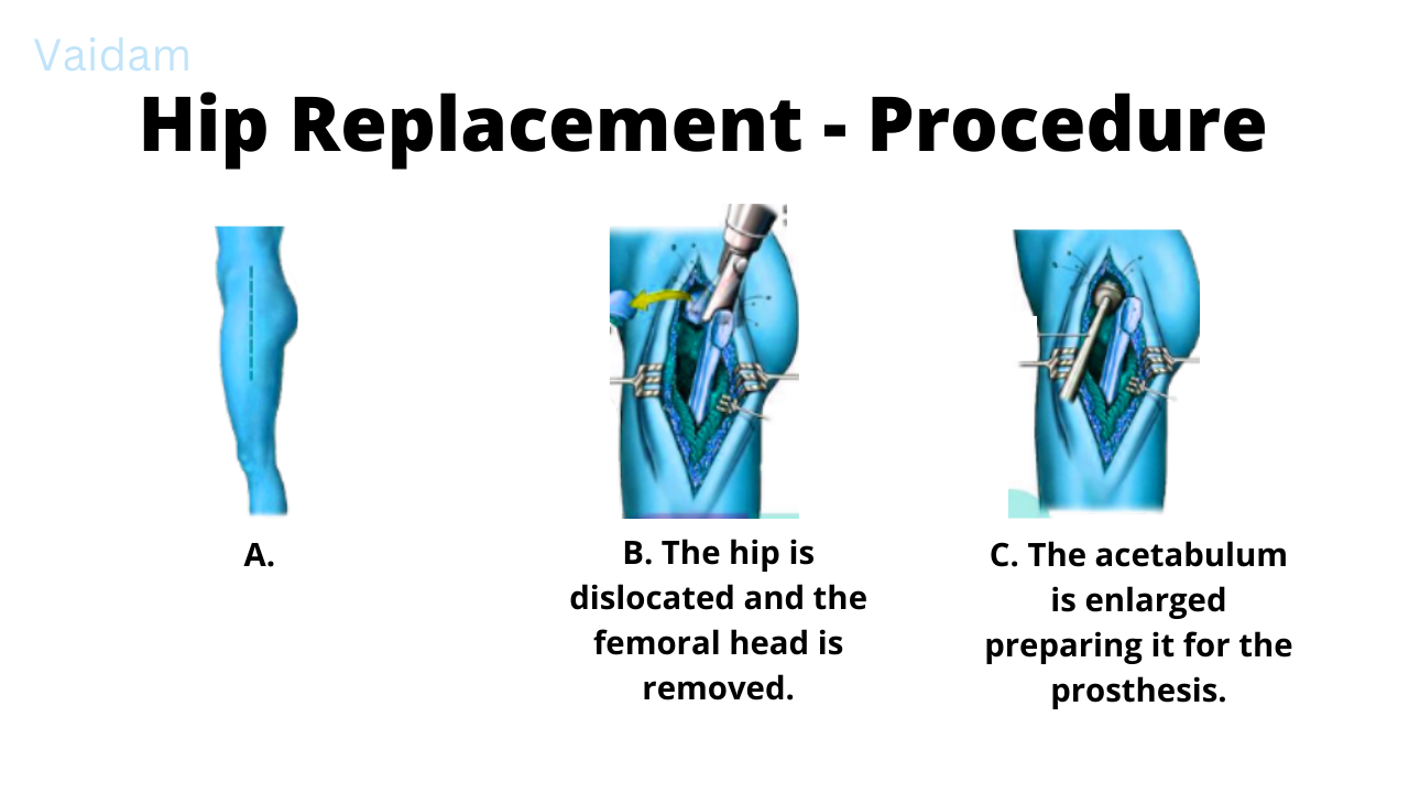  Procedure for Hip Replacement Surgery