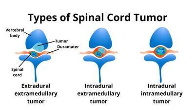 Types of Spinal Cord tumour.