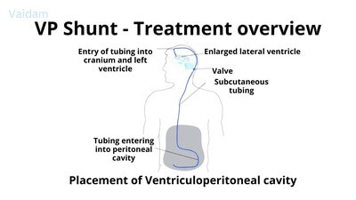 Treatment overview of VP Shunt.
