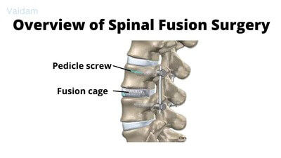 Overview of Spinal Fusion Surgery.