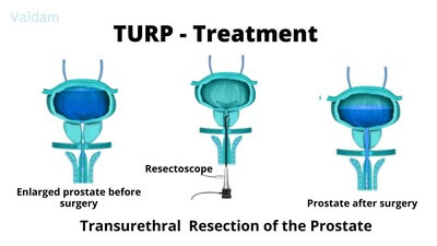 Treatment for TURP.