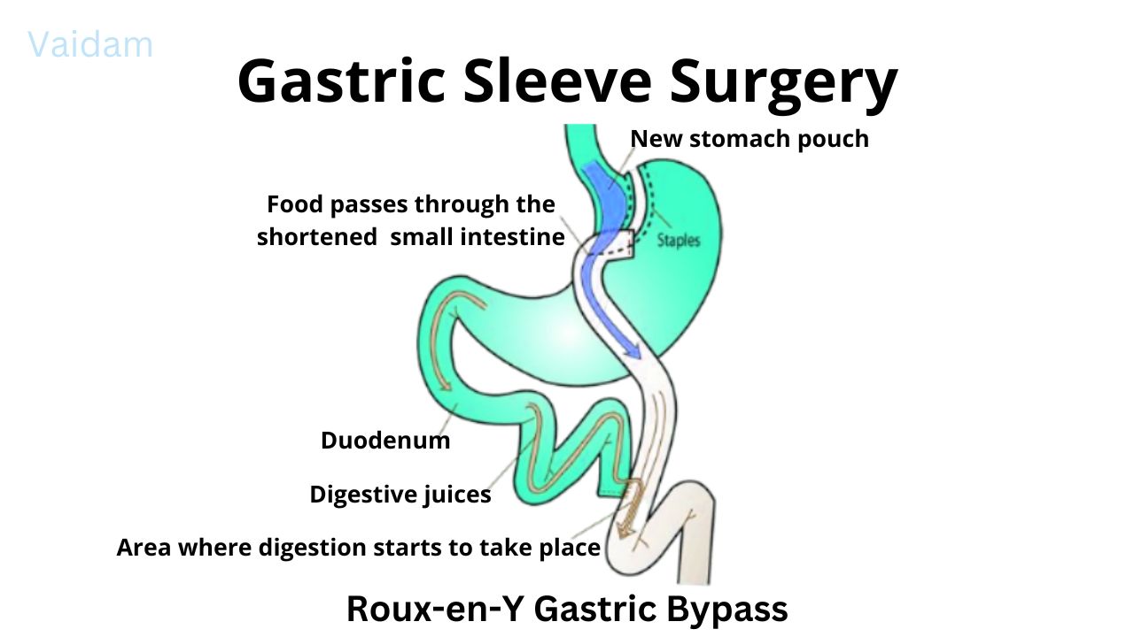 गैस्ट्रिक स्लीव सर्जरी की प्रक्रिया।