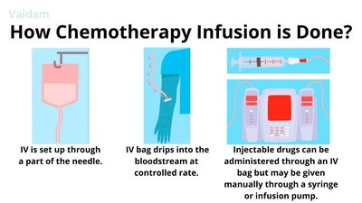 How Chemotherapy Infusion is Done?