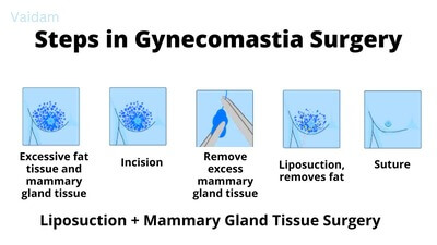 Steps in Gynecomastia Surgery.
