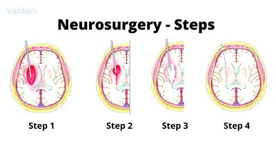  Procedural steps in Neurosurgery.