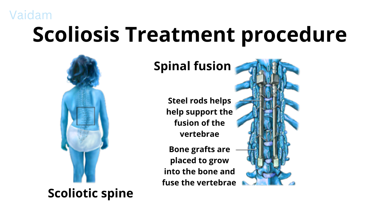  Scoliosis treatment procedure.