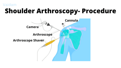  The procedure of shoulder arthroscopy treatment.