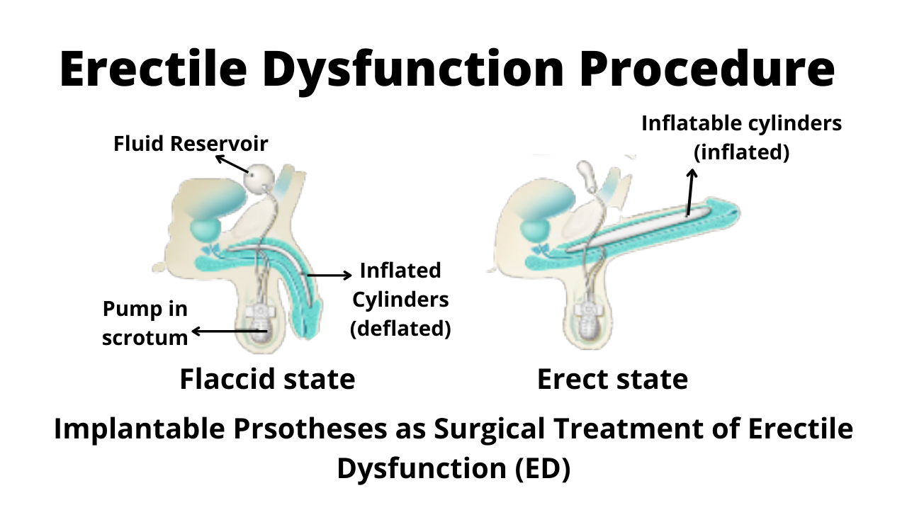  Procedure for Erectile Dysfunction Treatment.