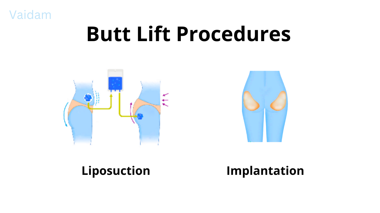 Types of Butt Lift procedure.