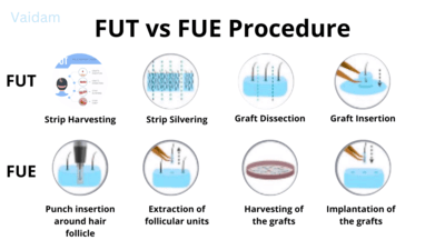 फॉलिक्युलर यूनिट ट्रांसप्लांटेशन (FUT) VS फॉलिक्युलर यूनिट एक्सट्रैक्शन (FUE) हेयर ट्रांसप्लांट प्रक्रिया।