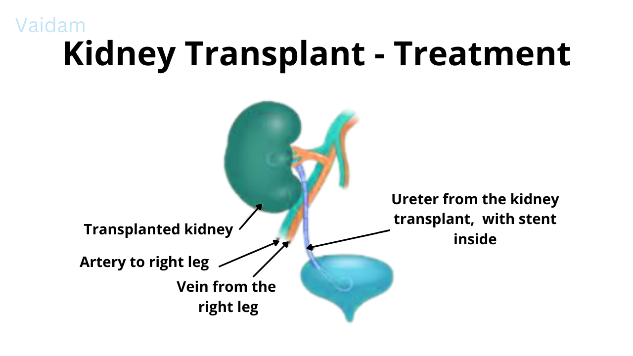 Kidney Transplant treatment.