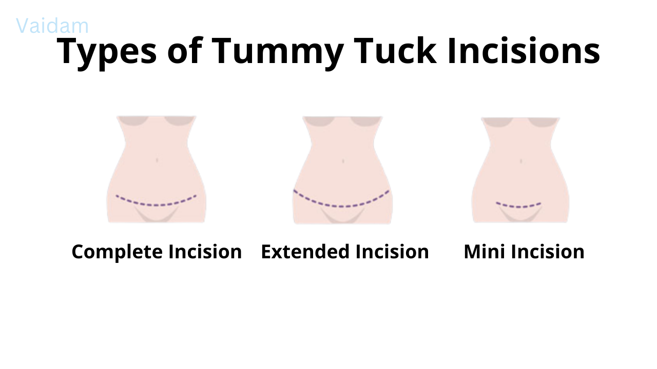 Types of Tummy Tuck incisions.