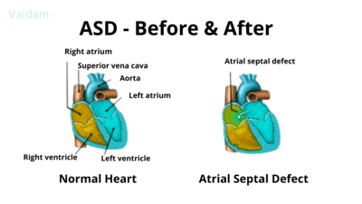  Before and after image of Atrial Septal Defect.