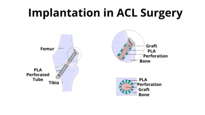 Implantation in Anterior Cruciate Ligament.