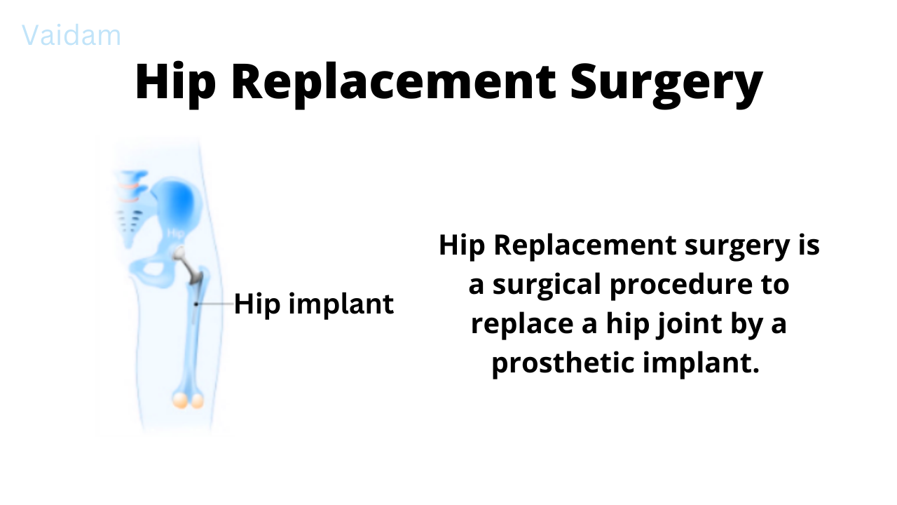  Hip Replacement Surgery
