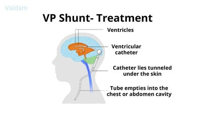 Treatment for VP Shunt.